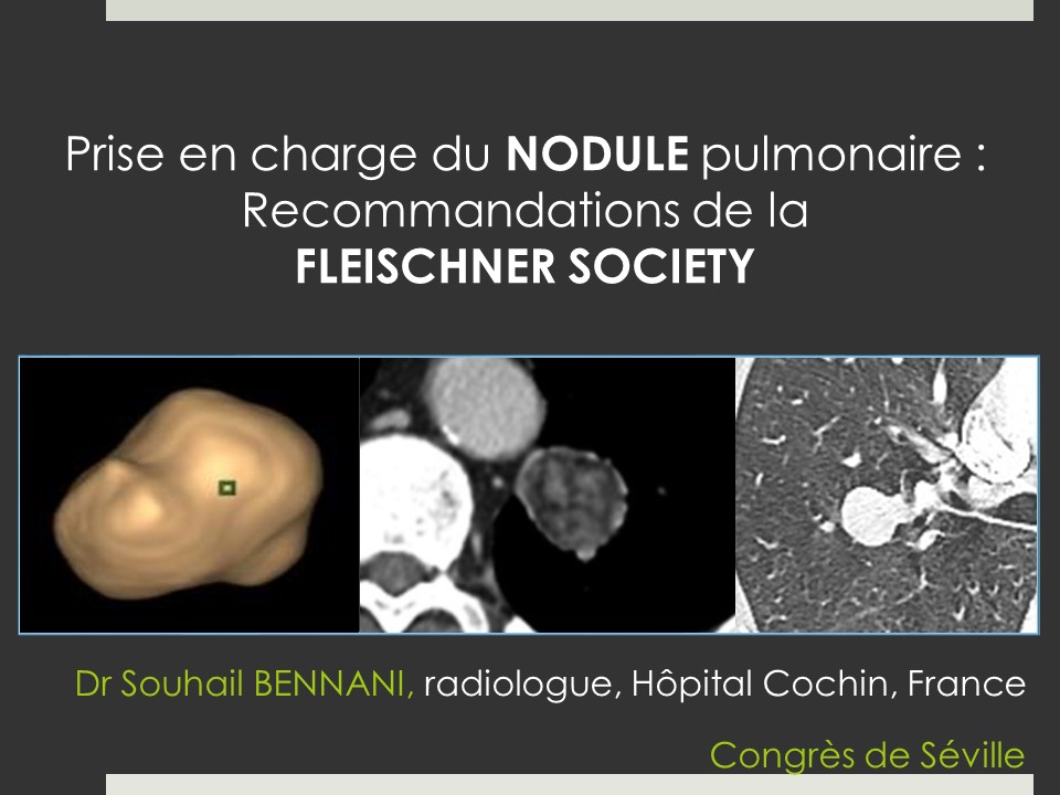 Prise en charge du NODULE pulmonaire : Recommandations de la FLEISCHNER SOCIETY. Souheil Bennani