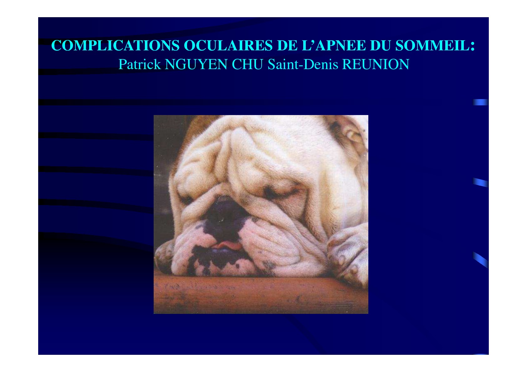 Complications oculaires de l'apnée du sommeil. Patrick NGUYEN