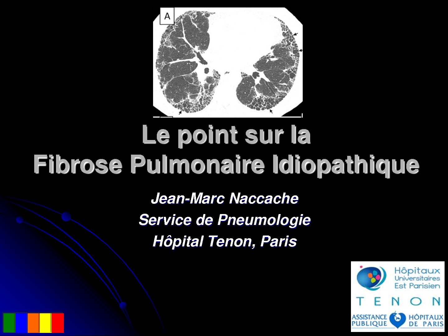 Le point sur la Fibrose Pulmonaire Idiopathique. Jean-Marc Naccache